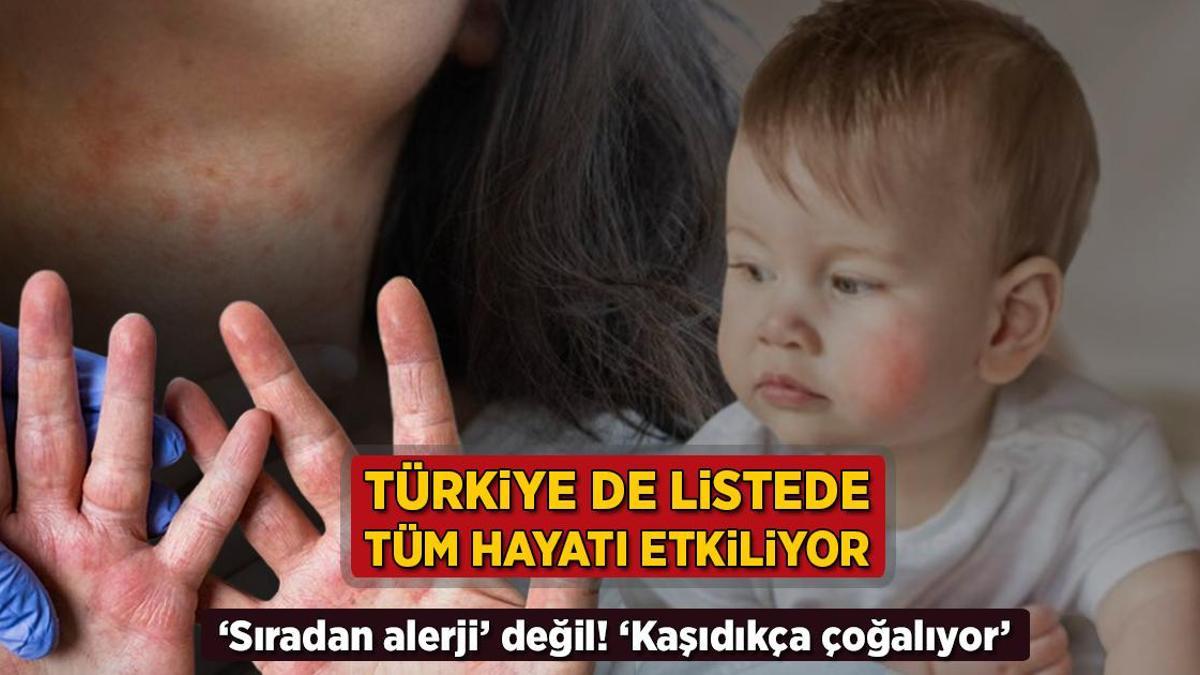 turkiye de listede tum hayati kotu etkiliyor siradan alerji degil kasidikca cogalir JSevzlBg.jpg